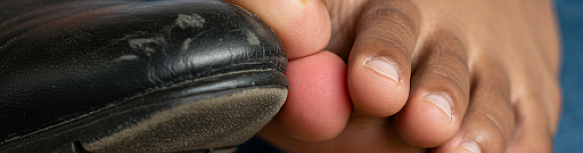 Ayakkabı Serçe Parmağımı Vuruyor, Ne Yapmalıyım?